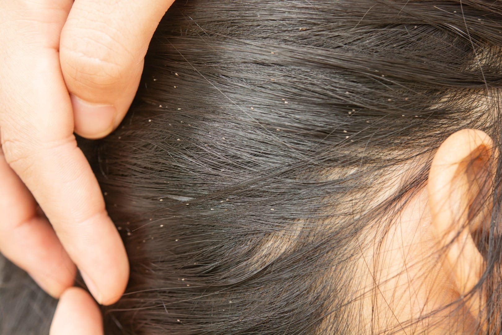 Fingers parting dark hair near an ear, revealing small pale specks