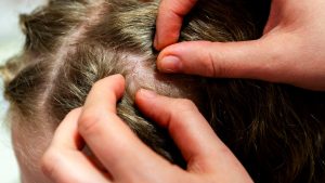 Which Lice Treatment Products Actually Work?