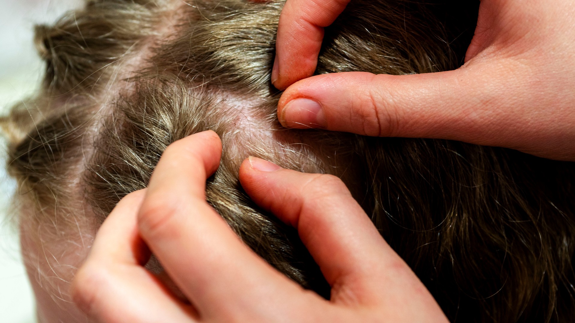 Which Lice Treatment Products Actually Work?