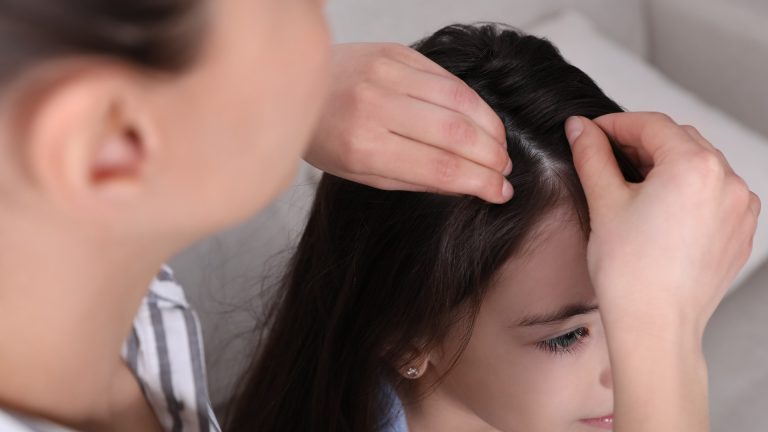 Hair Comes Out During a Lice Case for Reasons You Can Fix