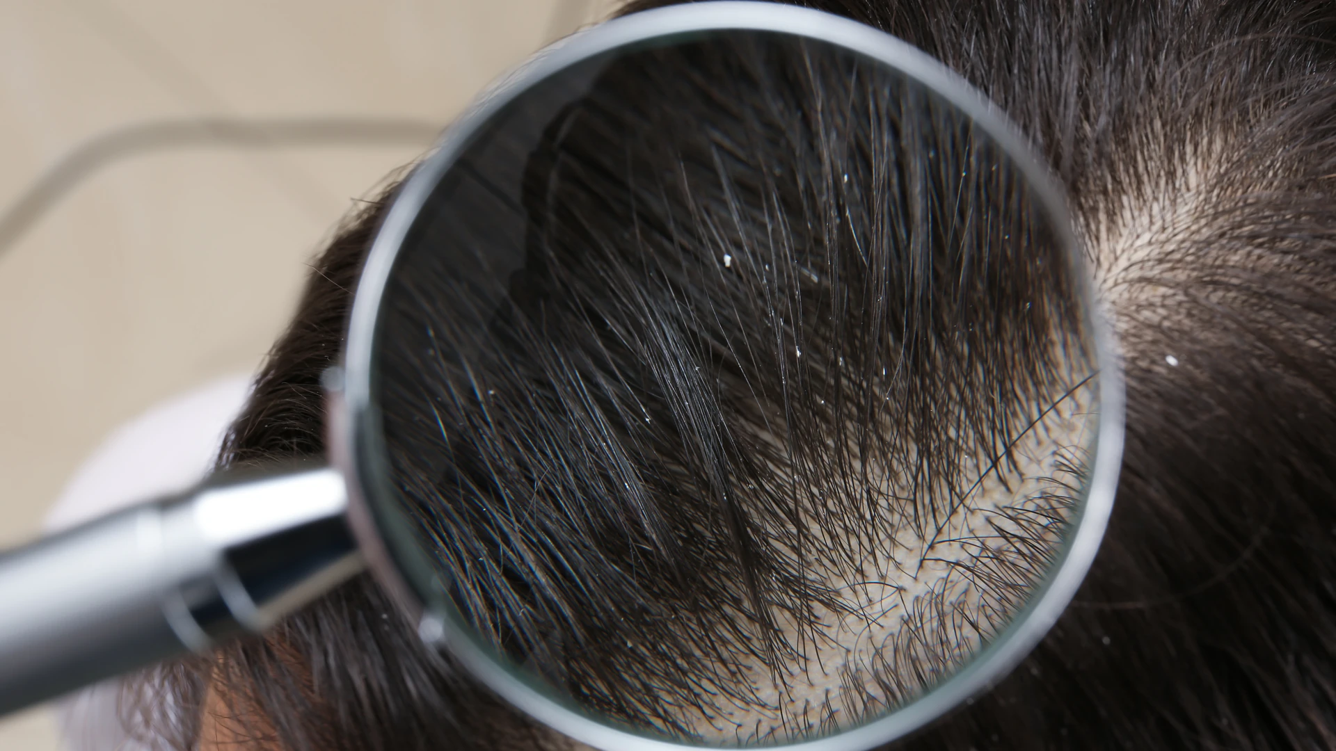 Magnifying glass held over dark hair at the scalp, showing small white specks along the hair shafts
